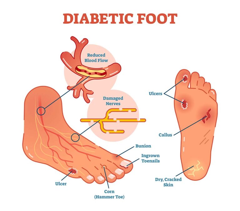Diabetic Foot Diagram
